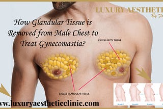 How Glandular Tissue is Removed from Male Chest to Treat Gynecomastia?