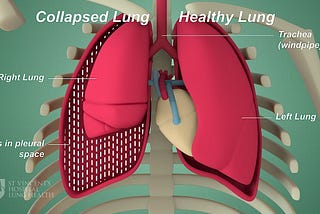 Detection and Semantic Segmentation of Pneumothorax Disease from X-Ray Images using Deep Learning