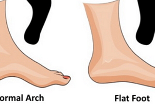 Let’s understand about Flat feet deformity