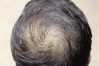 Male balding progresses at different rates in men?