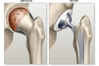 Knee Replacement Surgery, Step-by-Step Description