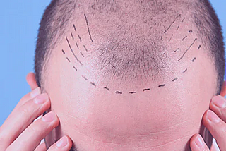 A Comprehensive Guide to Hair Transplant in Dubai for Men