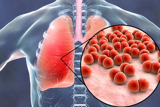 Nursing Care Plan for Pneumonia: Comprehensive Patient Management