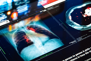 AI Unleashed: Shattering Barriers and Revolutionizing Lung Cancer Diagnosis and Care