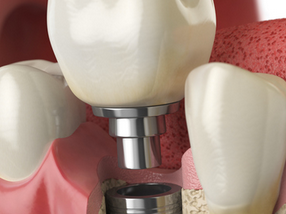 The break through of dental iplants — George Pegios