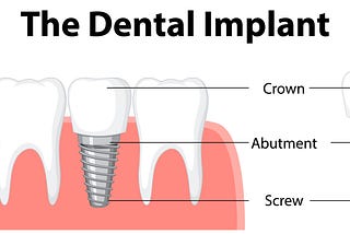 Dental Implants and Diabetes: What You Need to Know