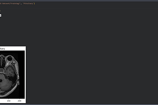 🧠 Brain Tumor Classification Using DenseNet169