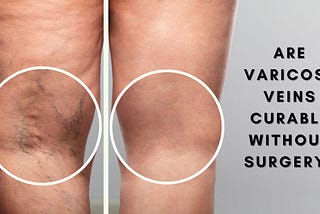 Are Varicose Veins curable without surgery?