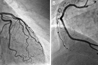 Left Main Heart Stent at Age 34: The Importance of Lipoprotein(a)