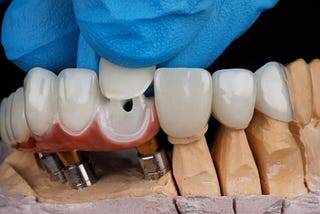 Different Types Of Dental Crowns: Pros And Cons