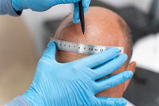 Hair Transplant Surgery: What You Need to Know