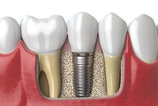 6 Facts You Need To Know About Dental Implants