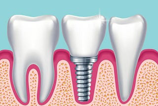 Dental Implants: The Cheaper Alternative