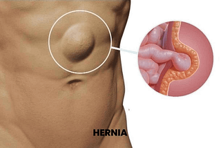 Himalaya Medicine for Hernia