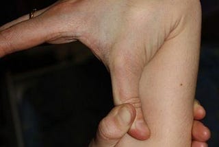 Ehlers-Danlos Syndrome