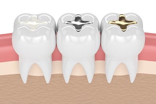 Understanding the Different Types of Tooth Fillings