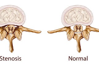 Is Chiropractic Safe For Spinal Stenosis?