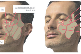『膠原蛋白增生劑』治療臉部凹陷