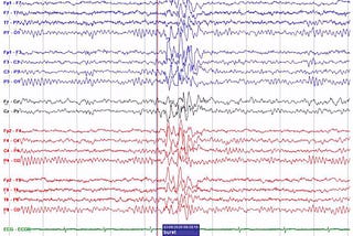 Image is an EEG tracing from a patient with epilepsy showing “spikes” (pointier) and “waves” (less pointy) of increased amplitude. There are several sets of waves in red, blue, or black.