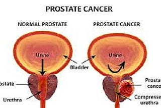 How effective is radiation therapy for treating prostate cancer?