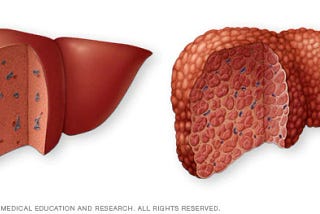 All you need to know about Liver Cirrhosis