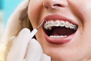 Types and Benefits of Orthodontic Treatment