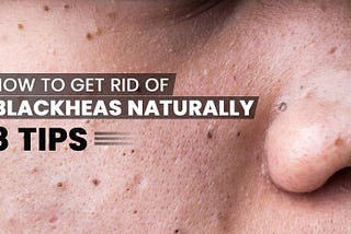 https://shopitlist.com/how-to-get-rid-of-blackheads-naturally-8-tips/