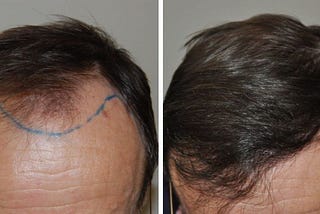 How Much Do Hair Implants Cost in Turkey?