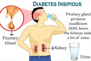 Understanding Diabetes Insipidus and its Treatment Options