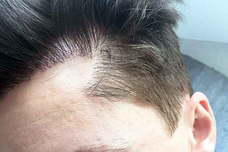 What is FUE Transplant?