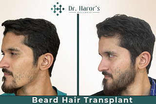 Is Beard hair transplant good option for Patchy beard