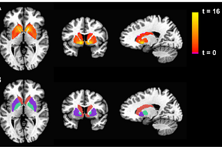 fMri Brain Scan of Political Viagra protein deposits