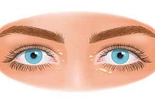 Xanthelasma Removal at Home