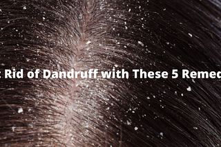 get rid of dandruff with these 5 remedies