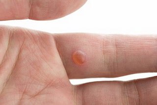 How To Get Rid From Trouble Of Warts?