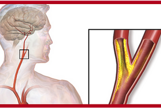 Carotid Artery Stenosis Awareness