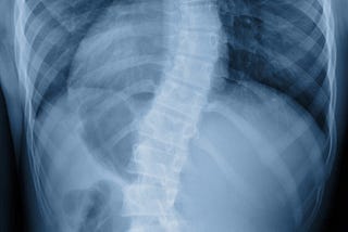 Scoliosis Revealed: Are kids too young for structural problems?