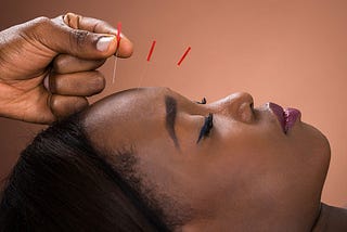 Health Benefits of Acupuncture for Stress