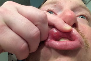 Mouth Pain Palooza 2017