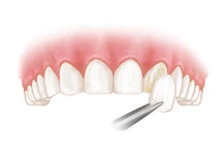 Problems With Veneers