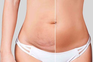 Want to Get a Flat Abdomen? A Tummy Tuck Can Help!