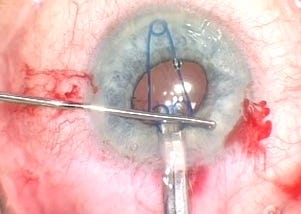 Complex Cases, Simplified (2): Malyugin Ring 2.0 plays an expanding role in small pupil surgery
