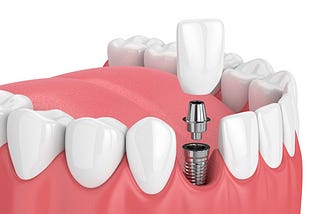 Joshua M. Ignatowicz, DMD | Professional Dental Implants in Henderson NV
