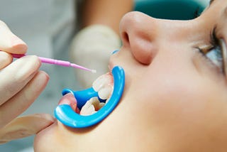 Sealants: A Key Tool in Preventing Tooth Decay