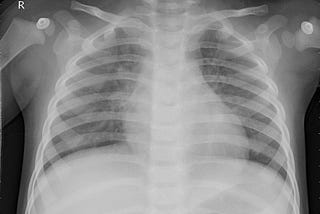 Python VAE and generating X-Ray Data