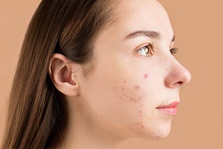 Acne Pimple Patches Do They Really Work?