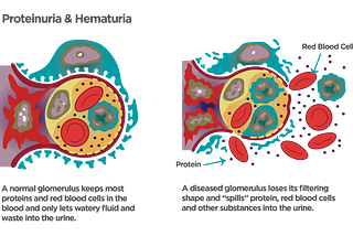 Proteinuria and nephrotic syndrome