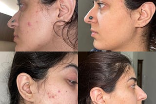 It Took Me 4 Weeks To Overcome My Lifelong Acne — Here’s How