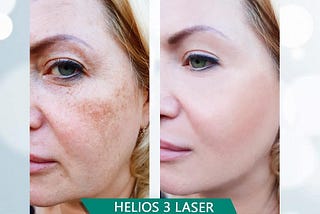 Laser Treatment Utilizes Centered Light Emissions To Treat Harmed Territories On The Body