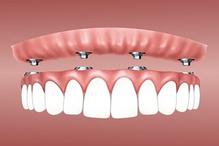 CAN 4 IMPLANTS REPLACE ALL MY TEETH? ALL ON 4 CONCEPT